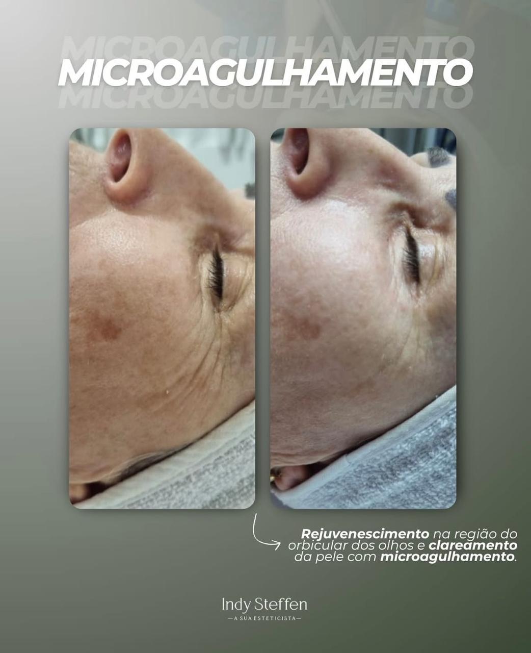 Microagulhamento